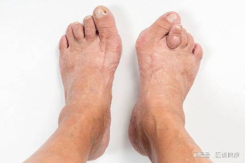 老人糖尿病头发痒怎么办 老人糖尿病头发痒怎么办