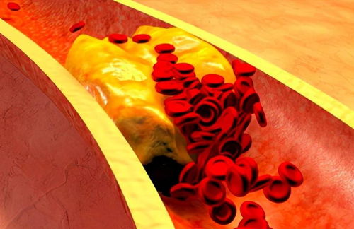 糖尿病心通颗粒 糖尿病人吃通心粉 糖尿病心通颗粒 糖尿病人吃通心粉