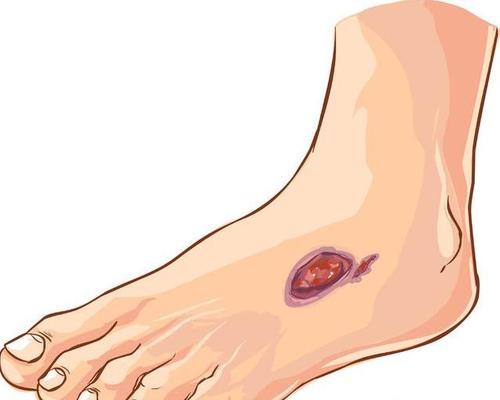 糖尿病能否安假肢护具 糖尿病能否安假肢护具