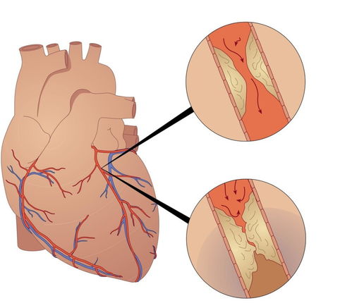 糖尿病控制多少才满意 糖尿病控制多少才满意